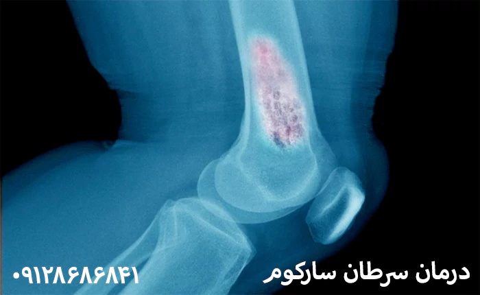 درمان سرطان سارکوم