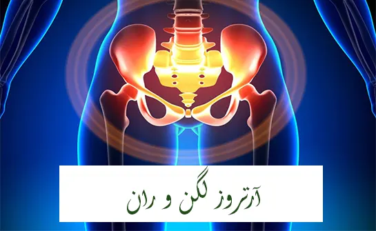 آرتروز لگن و ران