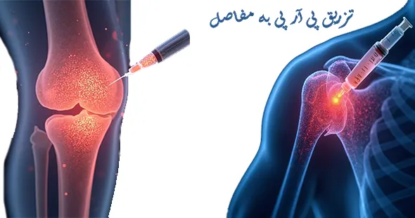تزریق پی آر پی به مفاصل