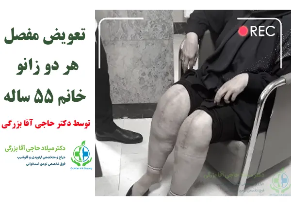 تعویض مفصل هر دو زانو