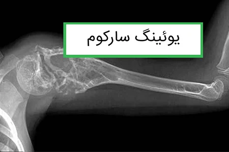 یوئینگ سارکوم