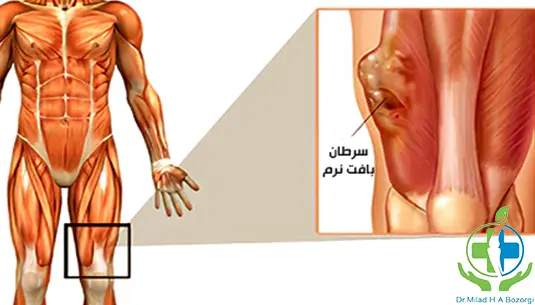 توده بافت نرم