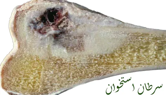 سرطان استخوان