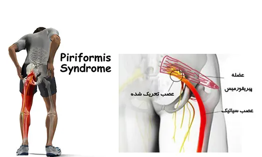 سندروم پیرفورمیس