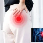 گرفتگی پیریفورمیس