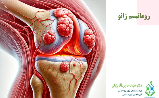 بیماری روماتیسم زانو