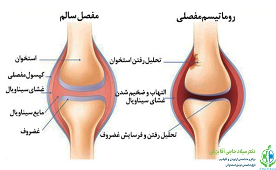 علائم روماتیسم