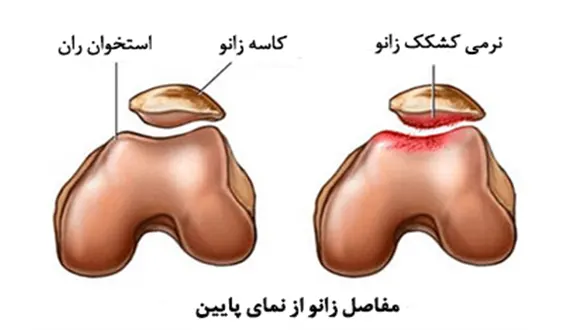 نرمی غضروف کشکک زانو