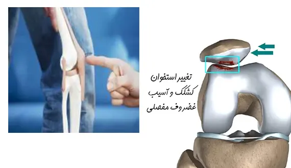 نرمی کشکک زانو