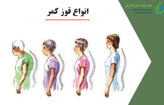 انواع قوز کمر