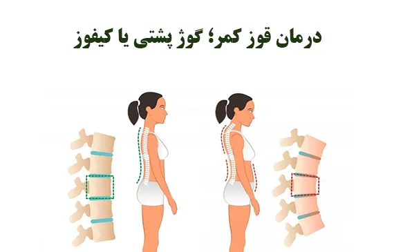 درمان قوز کمر