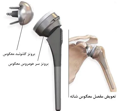 عمل تعویض مفصل شانه به صورت معکوس
