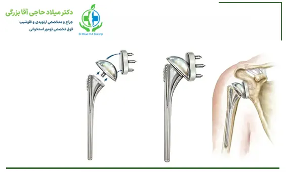 عمل تعویض مفصل شانه