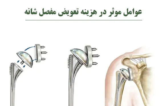 عوامل موثر در هزینه تعویض مفصل شانه