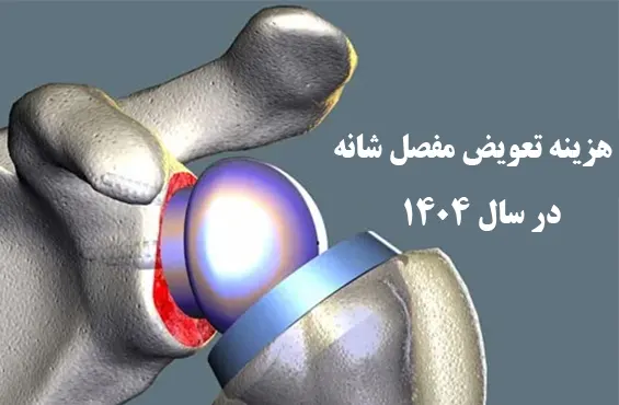 هزینه تعویض مفصل شانه