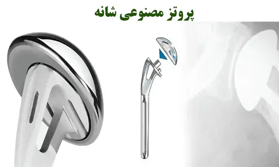  پروتز مصنوعی شانه
