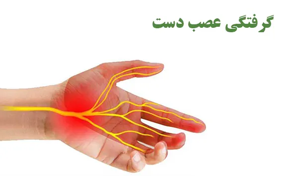 گرفتگی عصب دست
