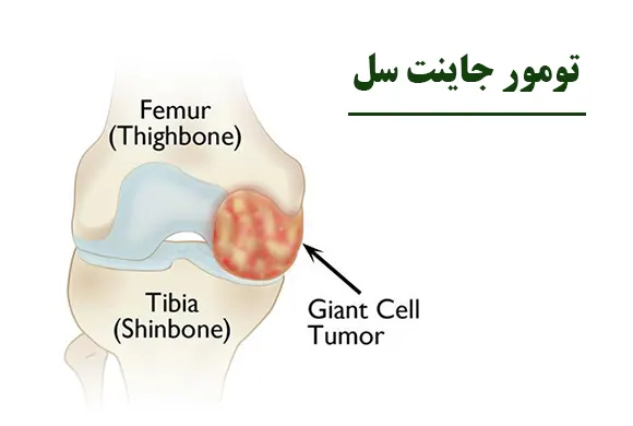 تومور جاینت سل