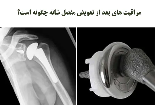 مراقبت های بعد از تعویض مفصل شانه