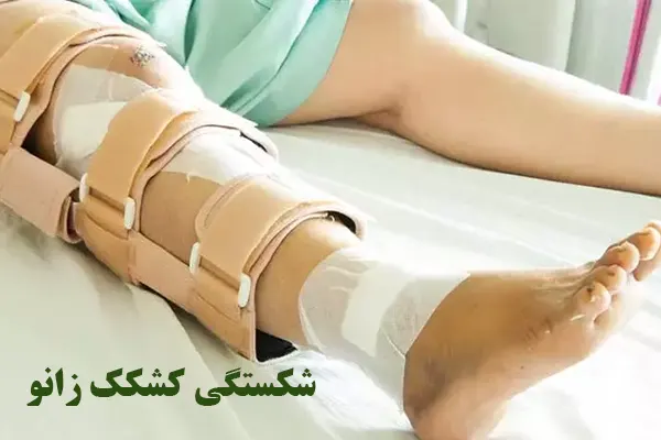 شکستگی کشکک زانو