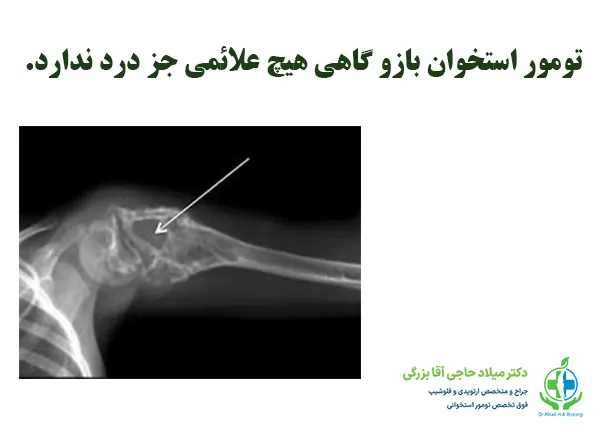 تومور های استخوانی بازو