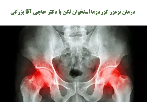 درمان تومور کوردوما استخوان لگن