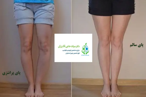 عکس پای پرانتزی و سالم