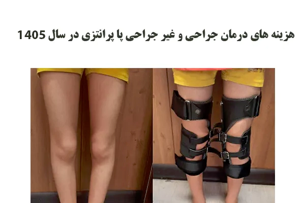 هزینه های جراحی پای پرانتزی