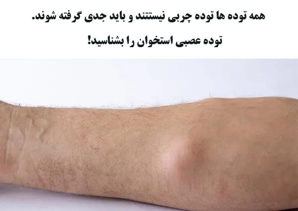 توده عصبی استخوان