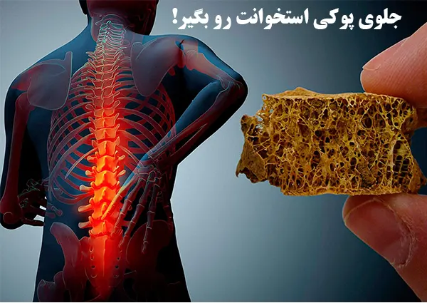 جلوی پوکی استخوانت رو بگیر!