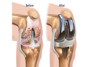 تعویض دو طرفه مفصل زانو