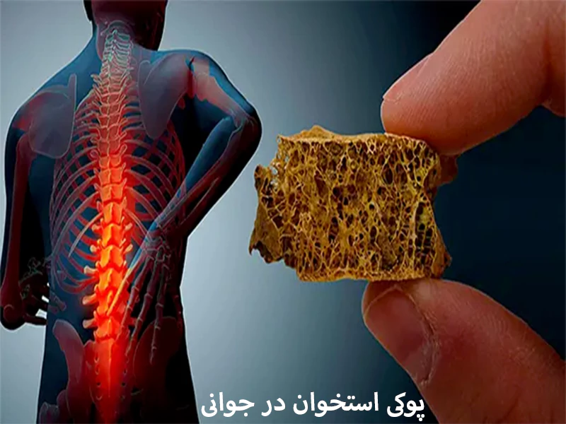 پوکی استخوان جوانان