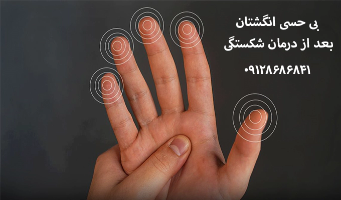 بی حسی انگشتان بعد از باز کردن گچ دست