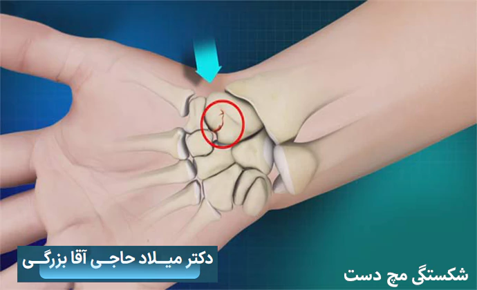 شکستگی مچ دست