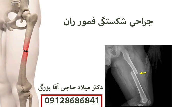 جراحی شکستگی فمور