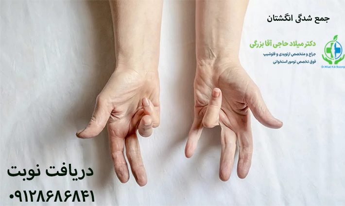 جمع شدگی انگشتان
