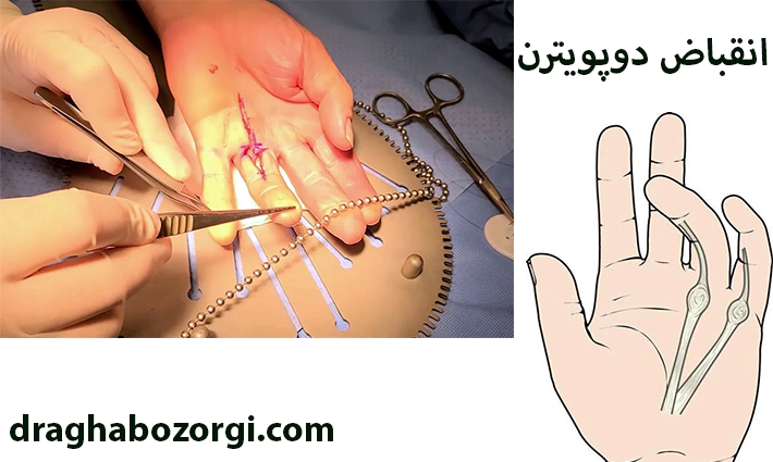 درمان انقباض دوپویترن