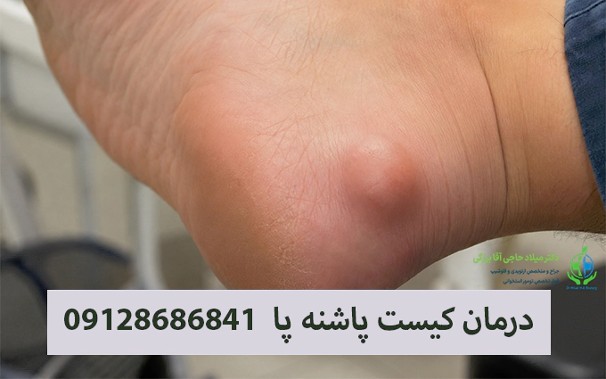 درمان کیست پاشنه پا در تهران