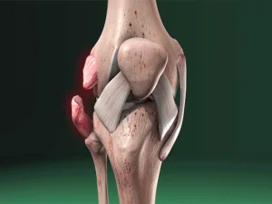 پاره شدن رباط خارجی زانو