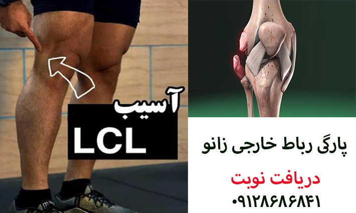 پارگی رباط خارجی زانو