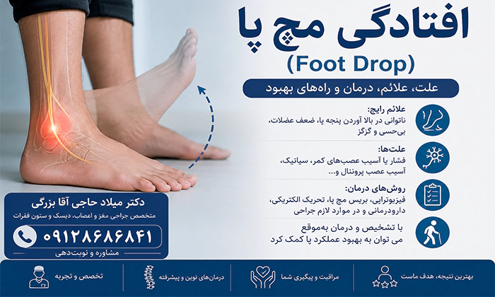 درمان افتادگی مچ پا