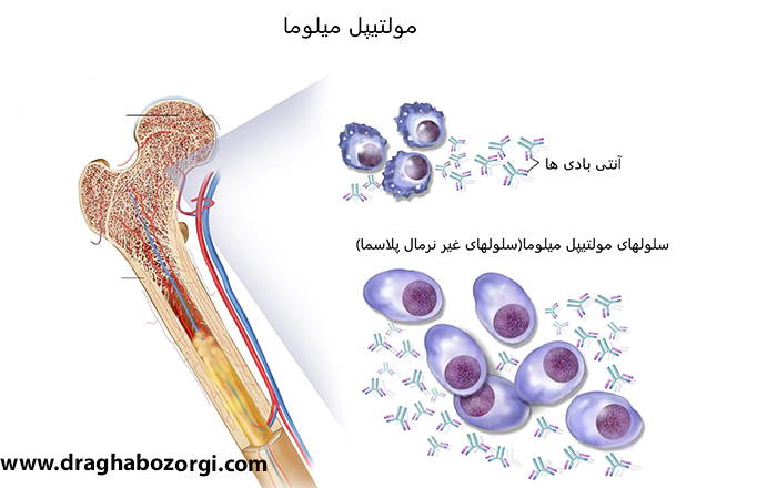پلاسموسیتوما
